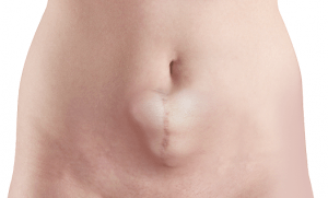 abdominal-wall-hernia