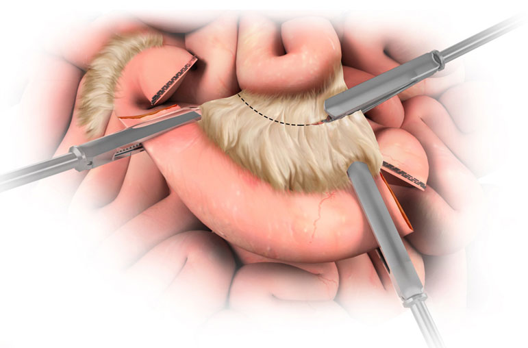 laparoscopic-bowel-resection