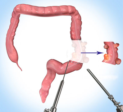 laparoscopic-colon-resection